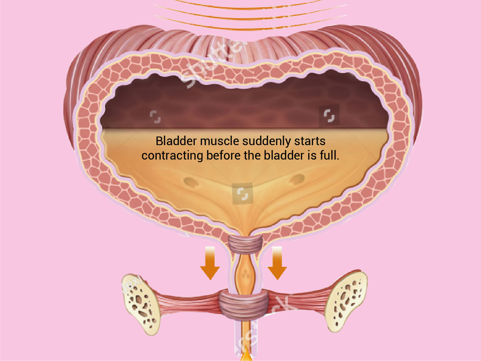 OAB Bladder